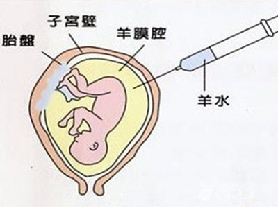 羊水穿刺