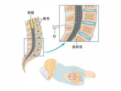 腰椎穿刺