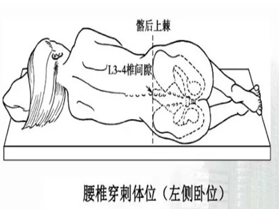 腰椎穿刺术