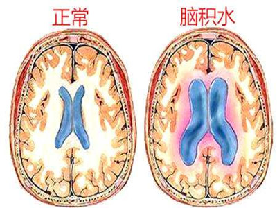 腰椎穿刺术