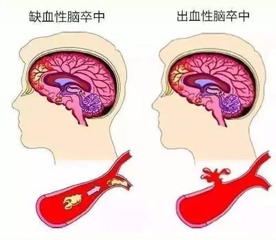 腰椎穿刺
